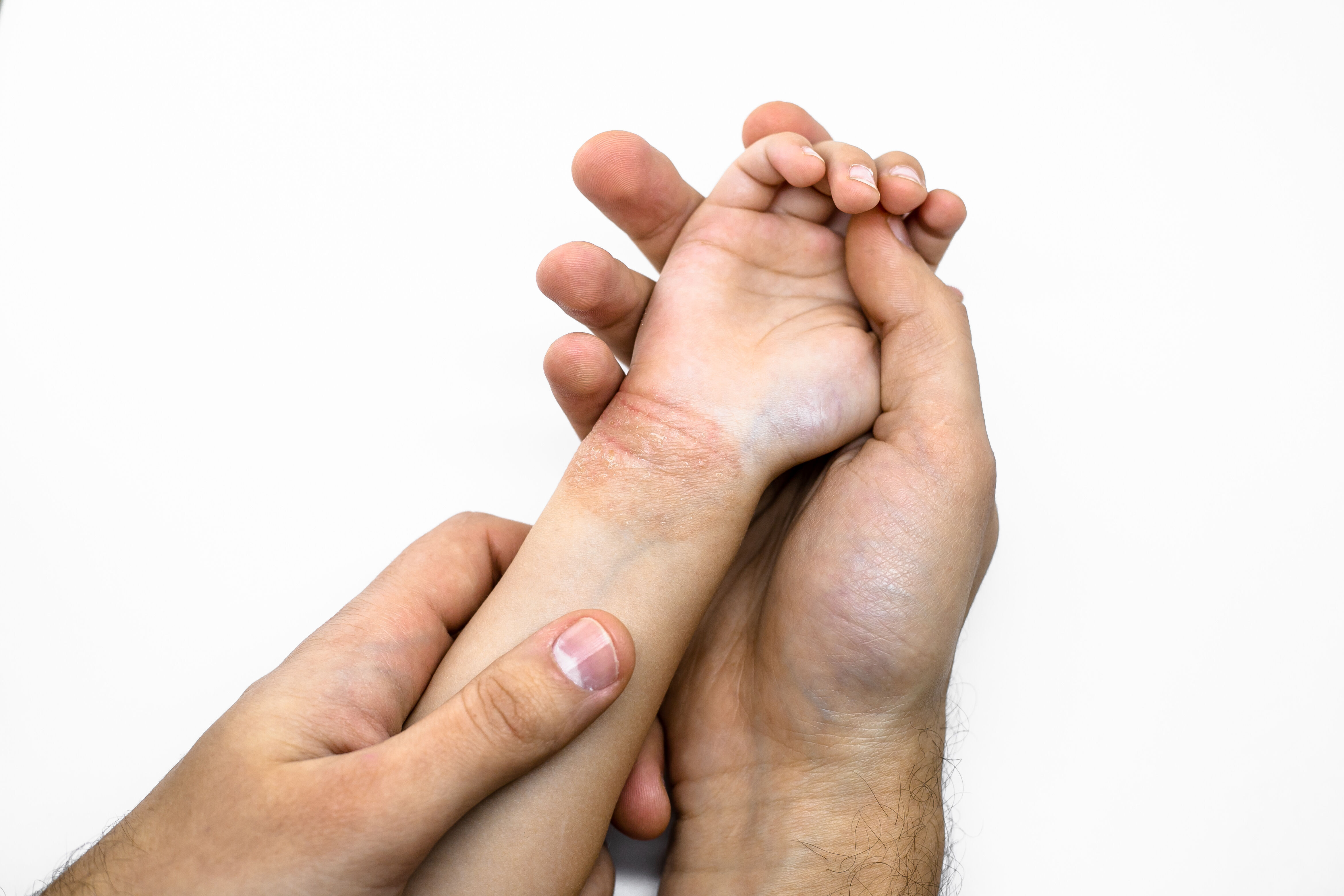 Baby hand with dermatitis