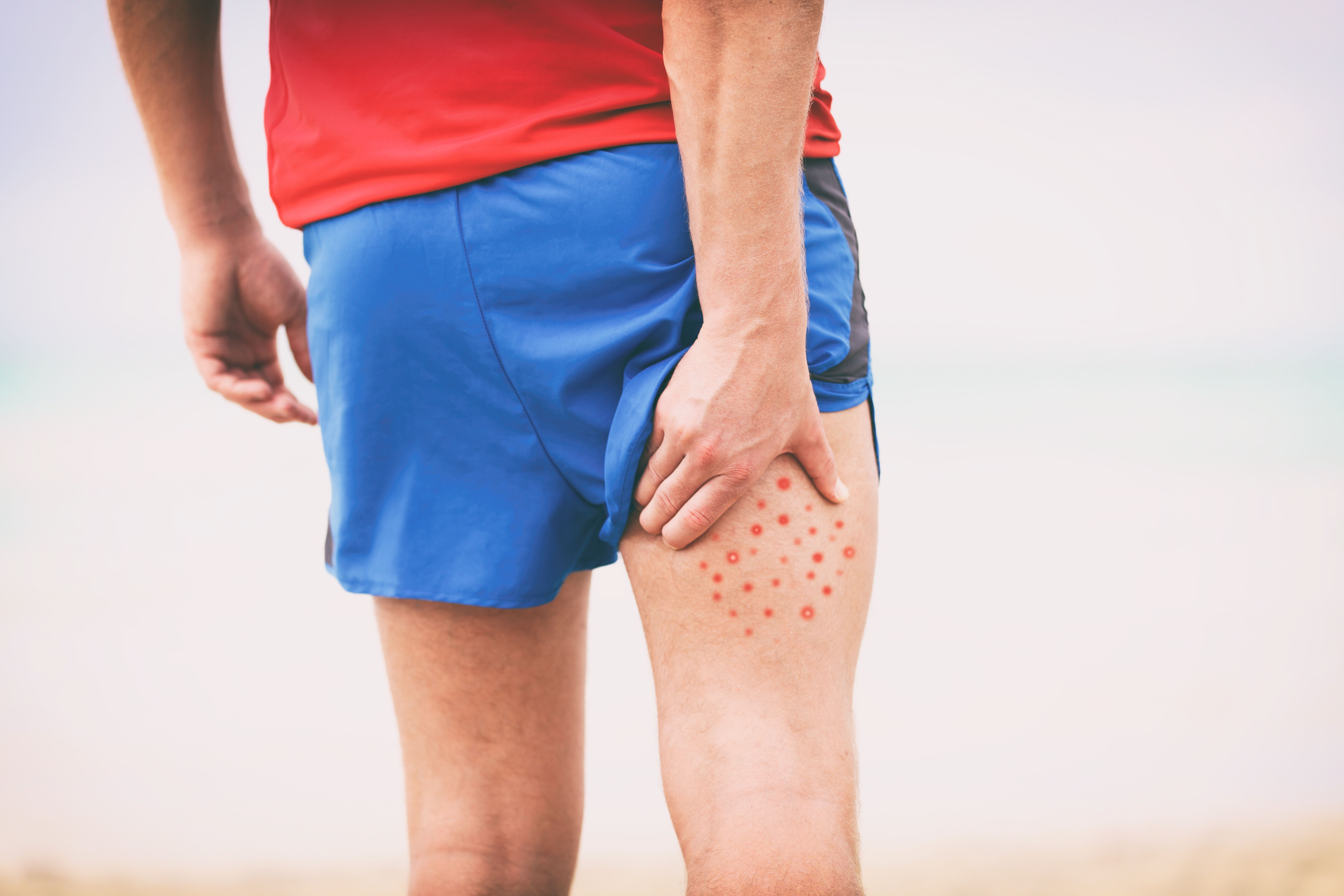 Poison ivy rash on the thigh