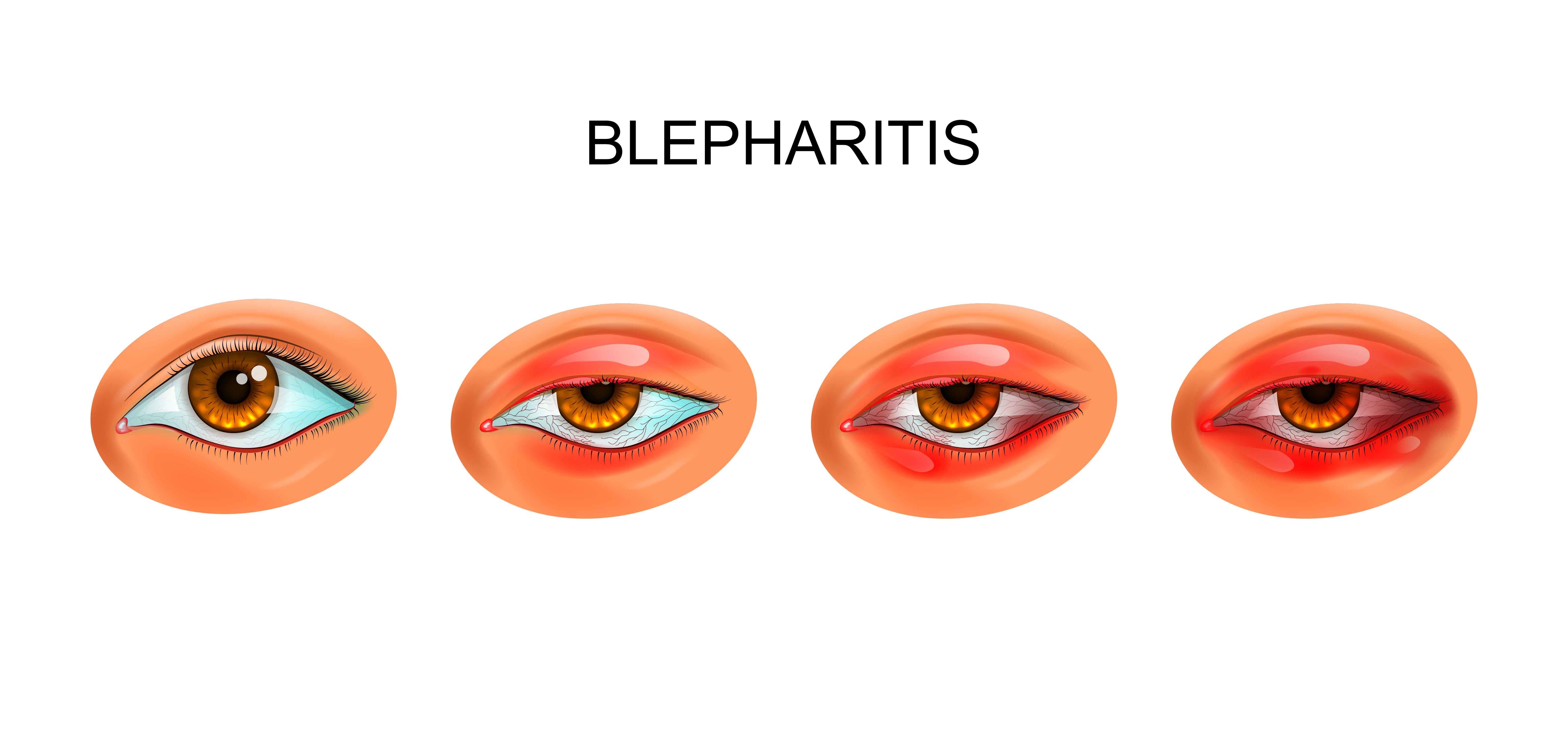 A condition such as blepharitis