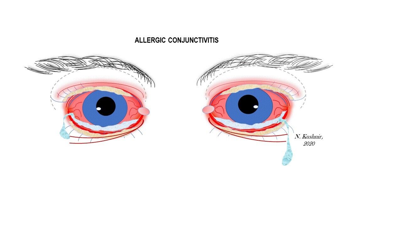 allergic conjunctivitis