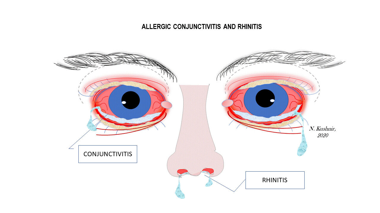 allergic conjunctivitis and rhinitis