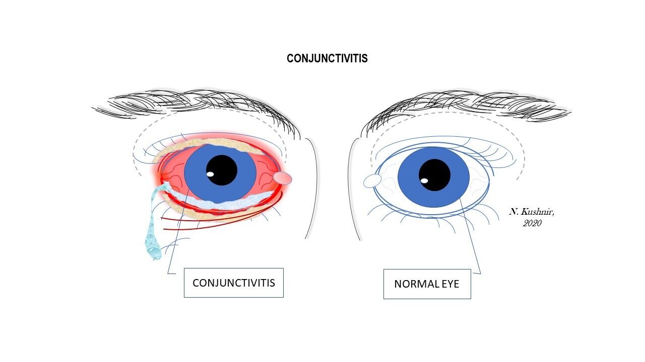 Conjunctivitis and normal eye 